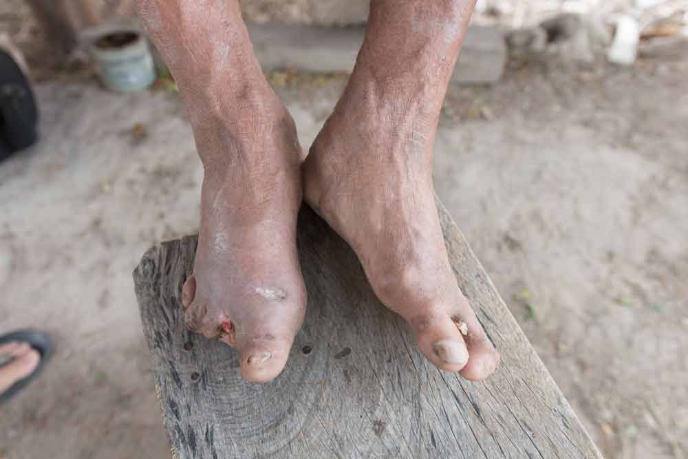 man suffering from leprosy