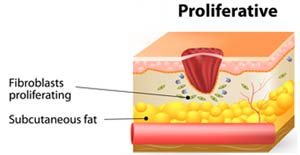 proliferative stage of wound healing