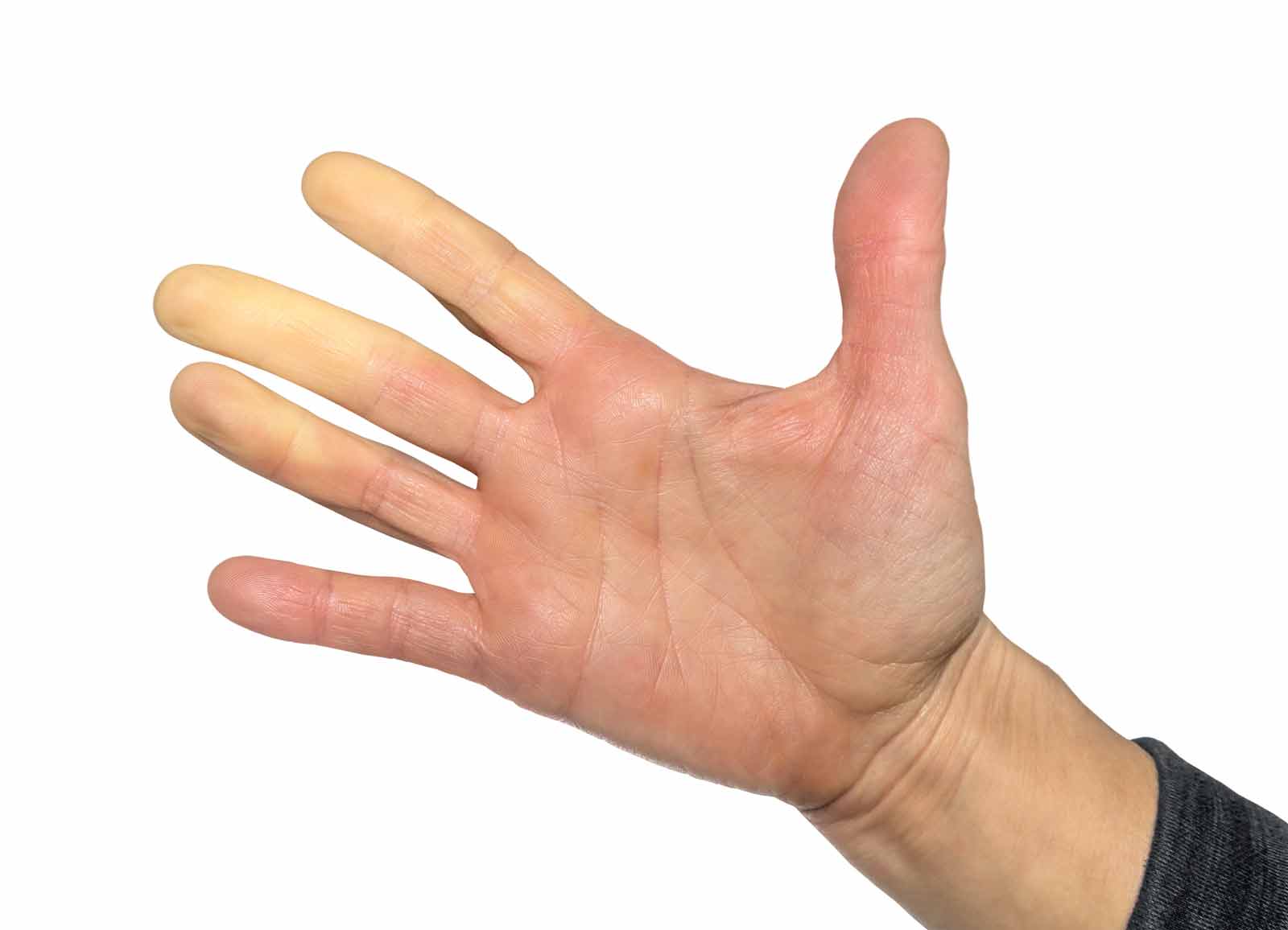 raynaud's phenomenon shows fingers looking white due to lack of akdquate blood circulation