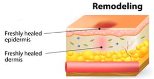 remodeling stage of wound healing