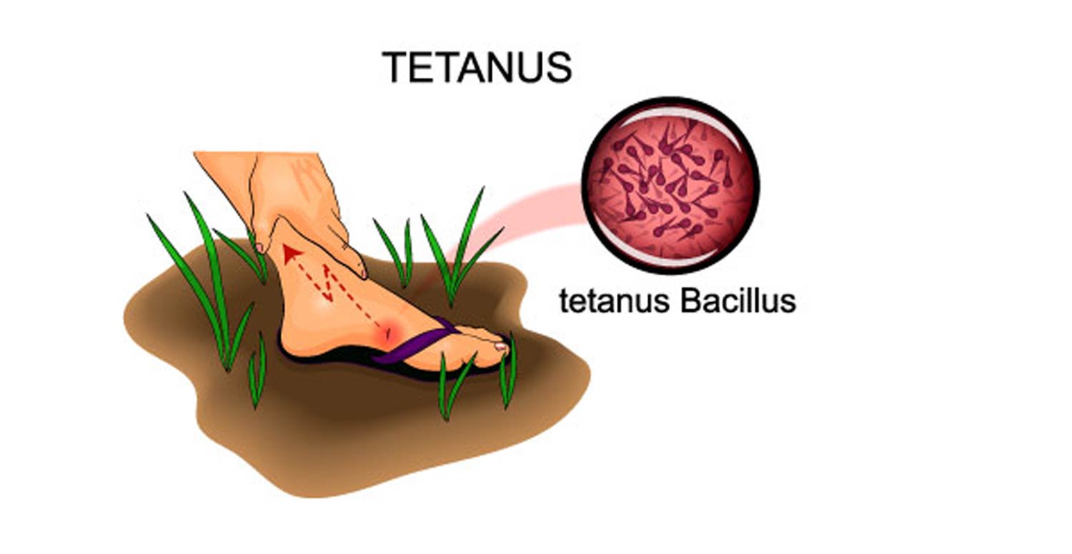 risk of tetanus if wound contaminated with soil