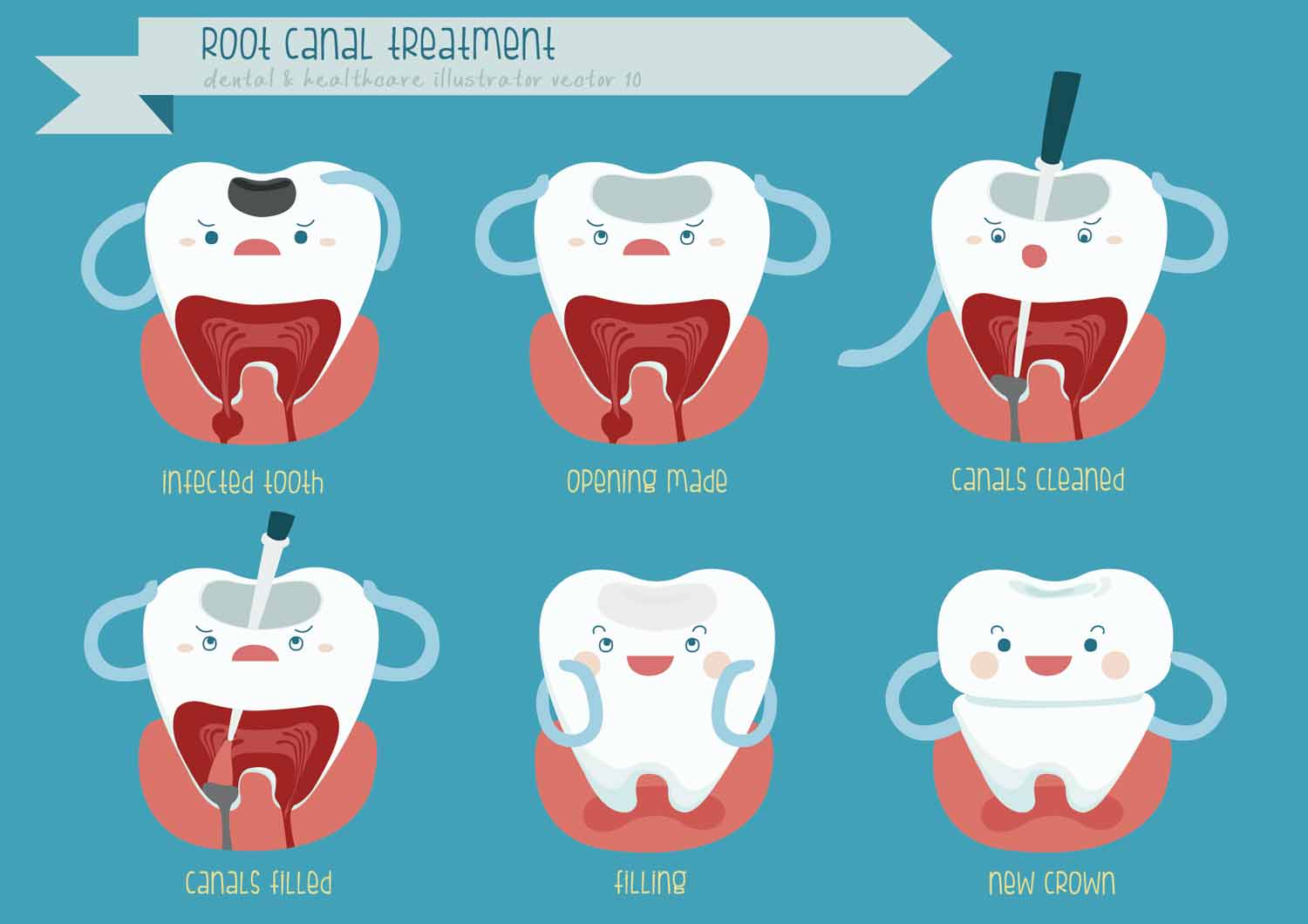 root canal treatment