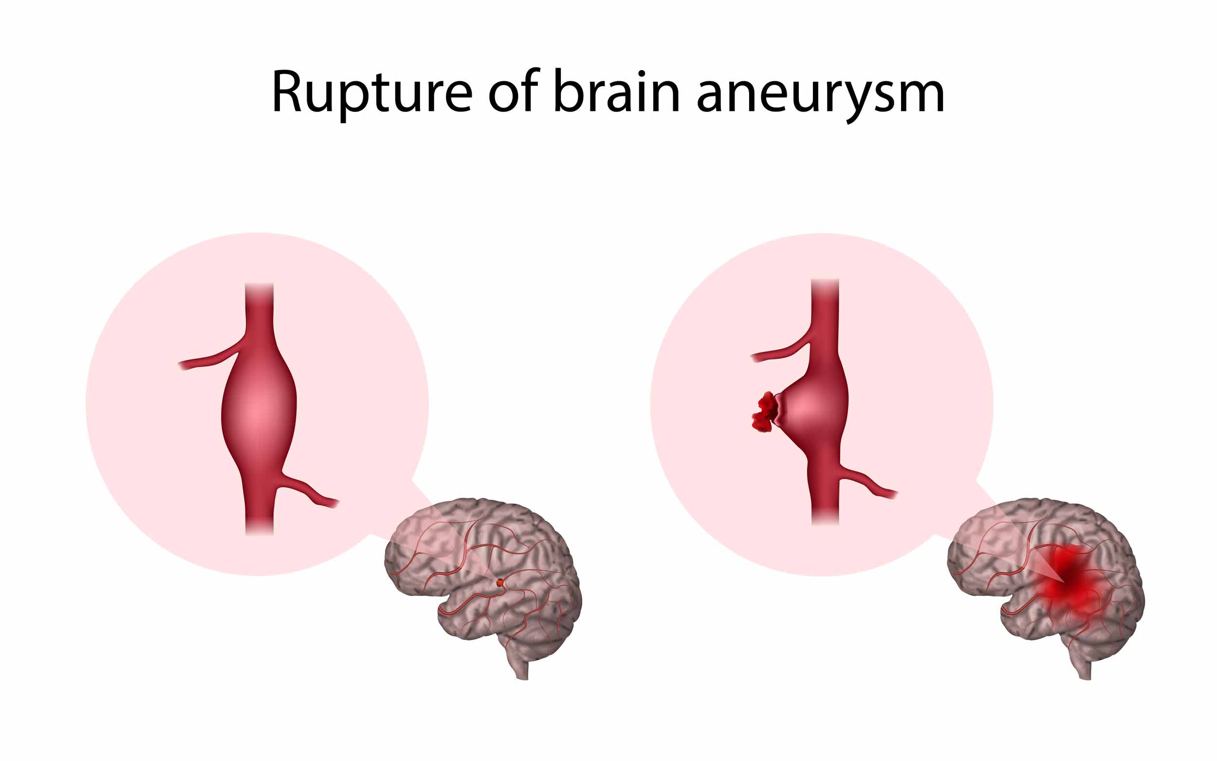 rupture of a brain aneurysm
