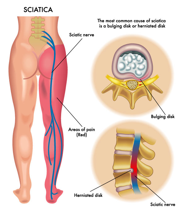 sciatica is a common traumatic condition that can cause numbness