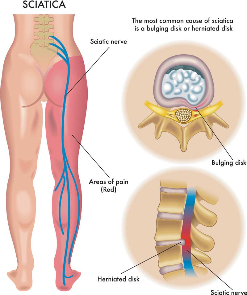 sciatica anatomical illustration
