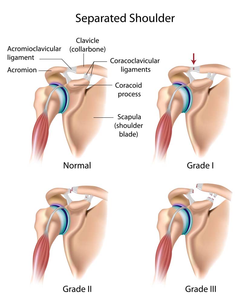 separated shoulder diagram 