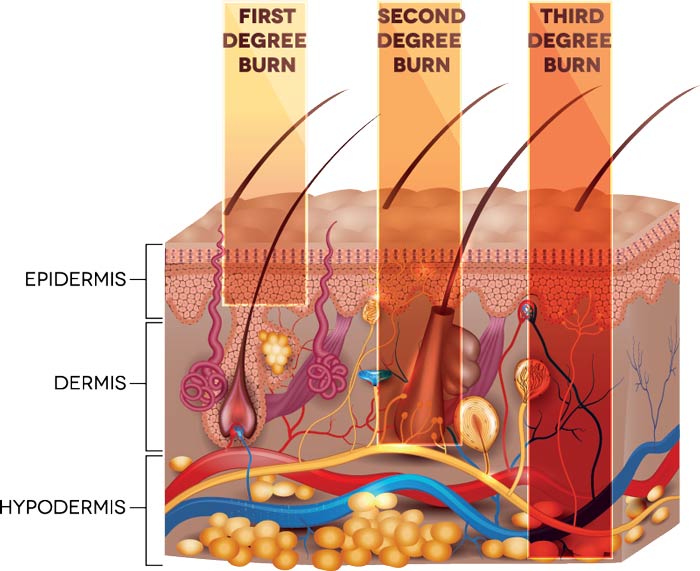 skin burn classification - first, second and third degree skin burns