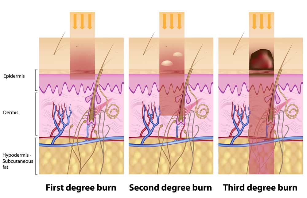 skin burn degrees
