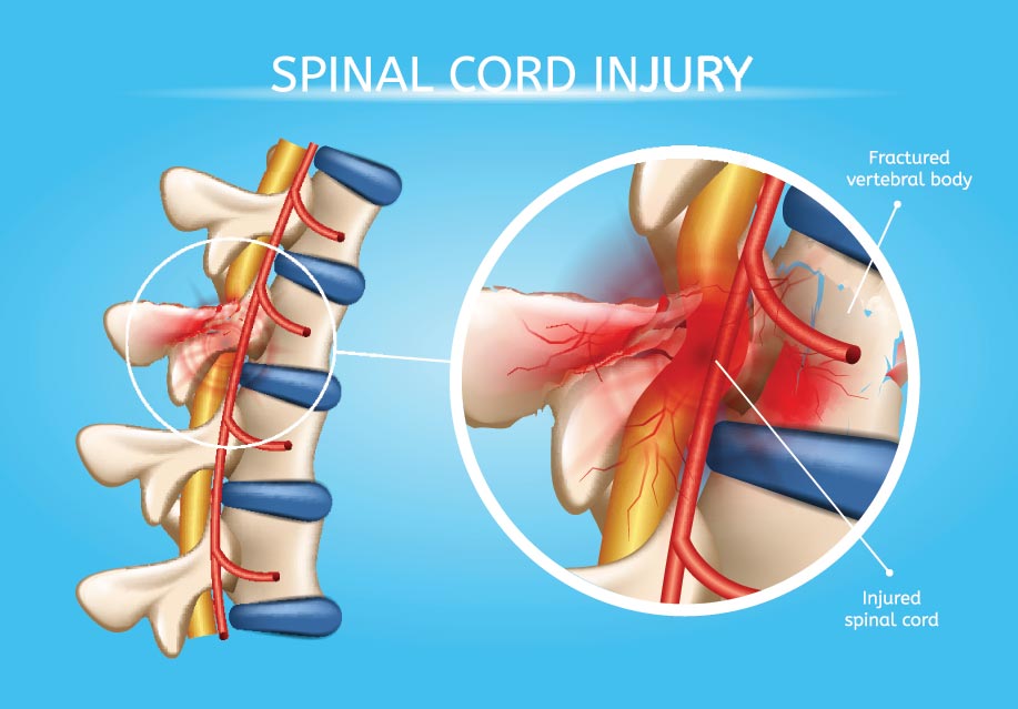 spinal cord injuries