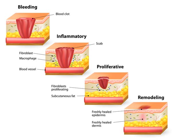 stages of wound healing - bleeding , inflammatory, proliferative, remodeling