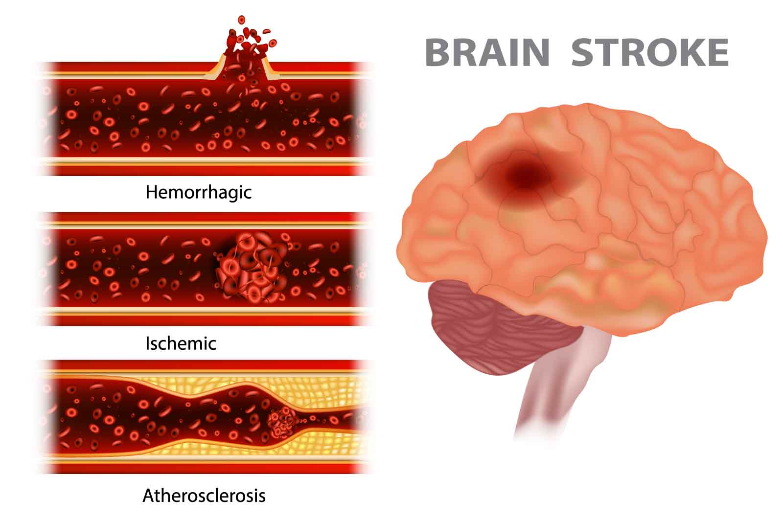 brain stroke types include atherosclerosis, ischemic and hemorrhagic