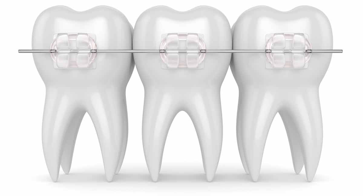 teeth with ceramic clear braces