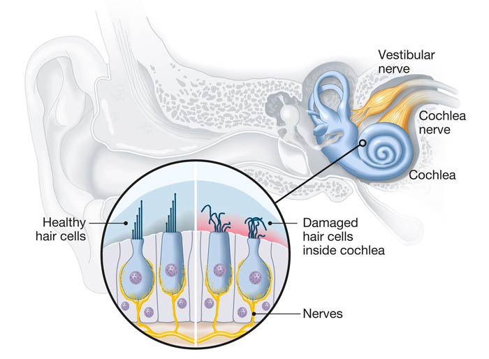 tinnitus healthy and damaged hair cells inside cochlea