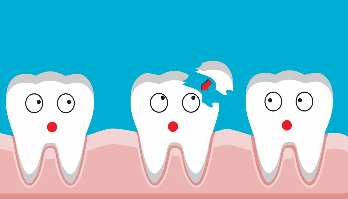 tooth fracture