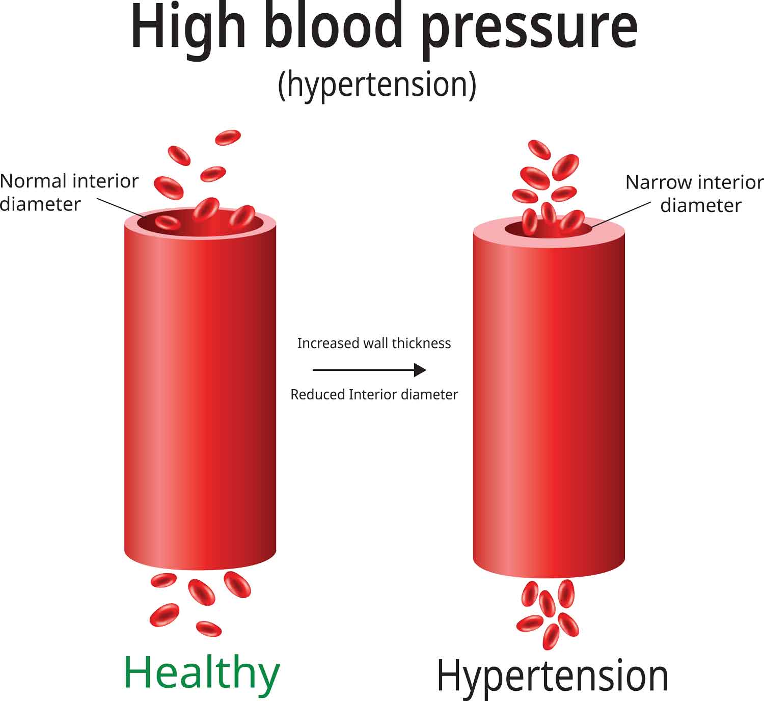 two blood vessels - one healthy and one with hypertension