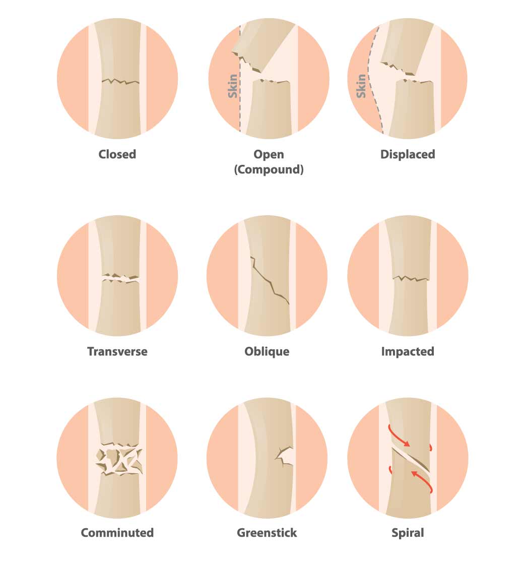 typeof fracture in circle illustration