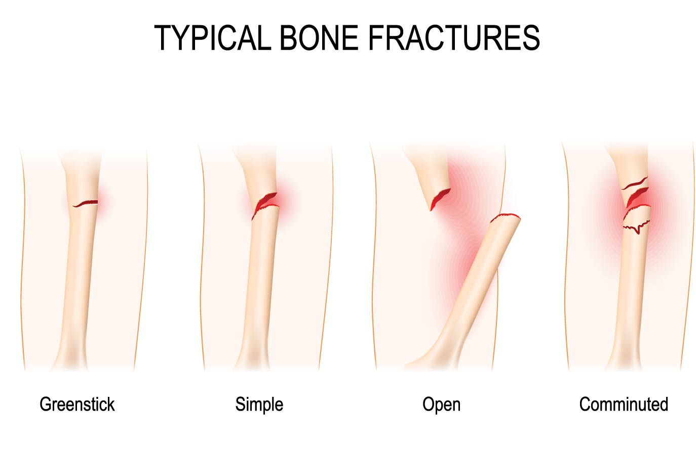 typical types of bone fractures