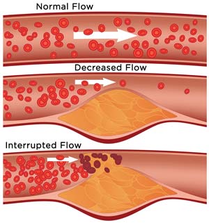 vascular interruption of normal blood flow