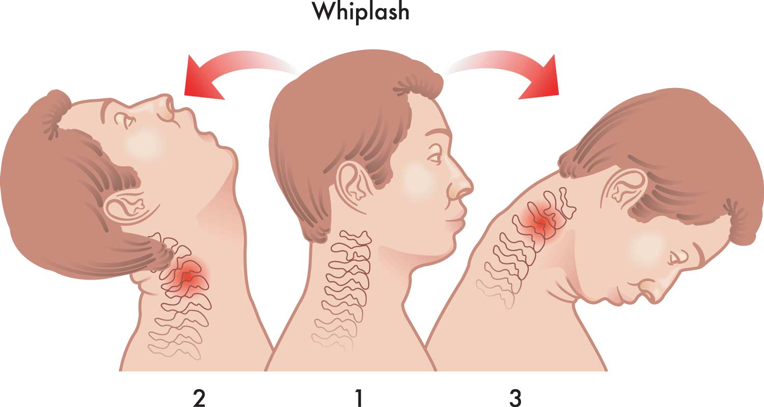 whiplash  injury