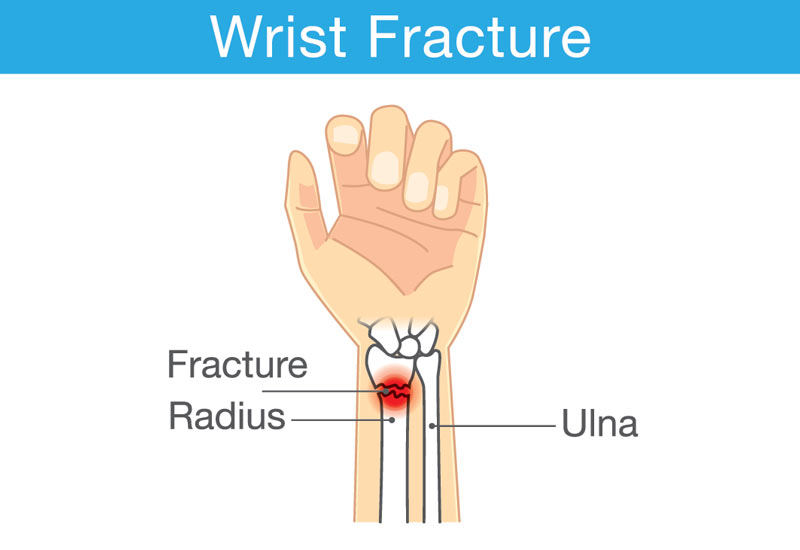 diagram of wrist fracture