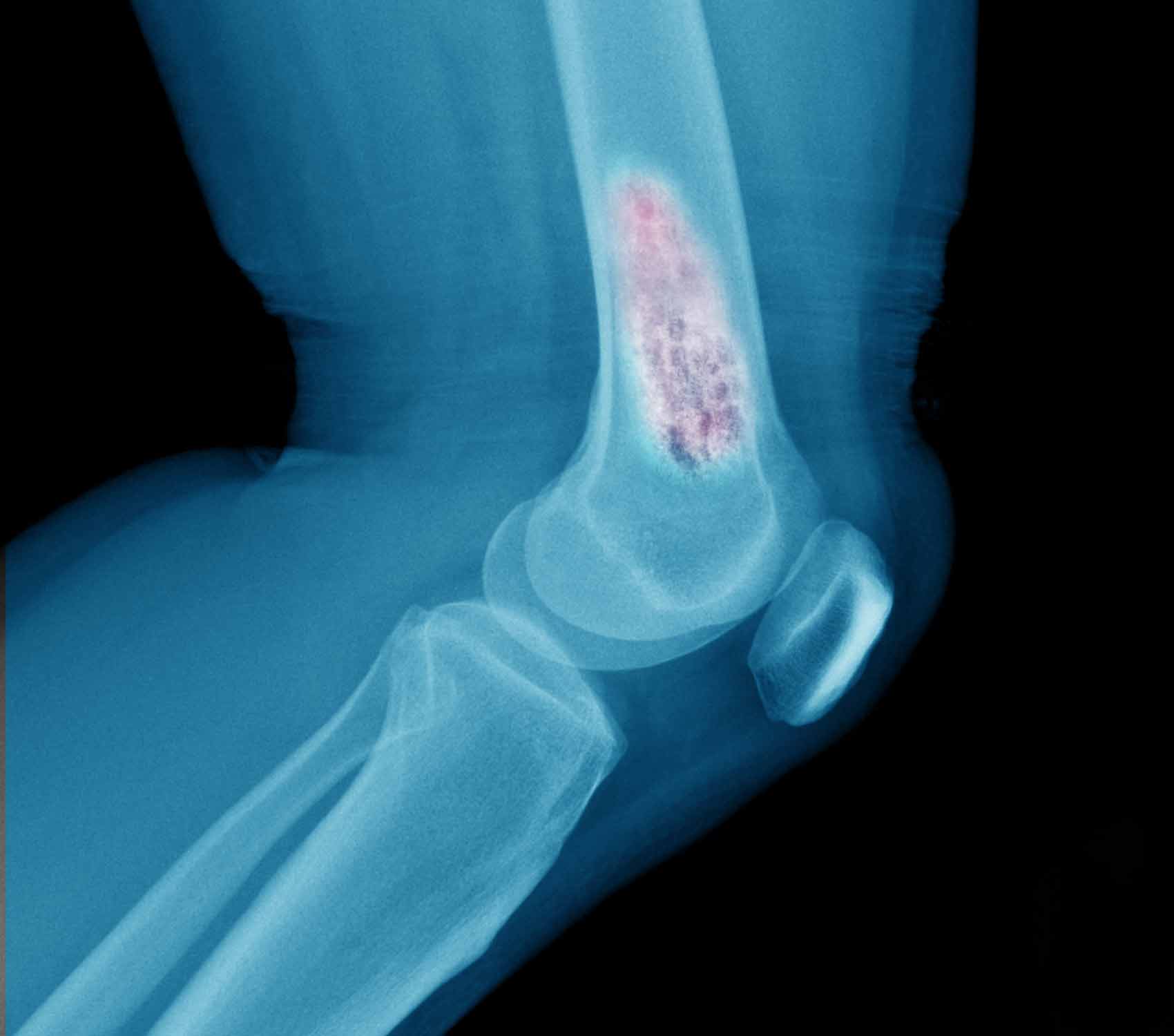 x-ray of bone cancer in leg