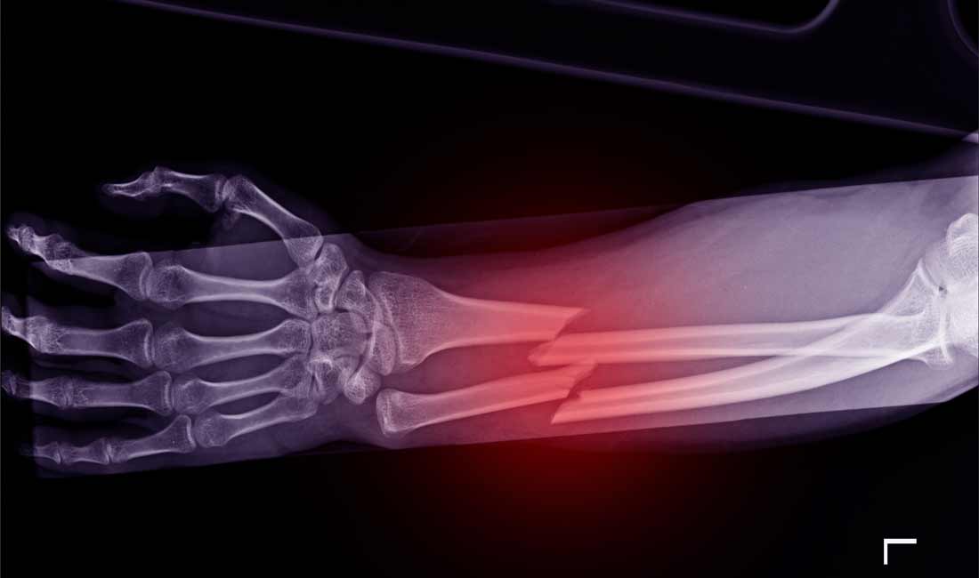 x-ray forearm fracture shaft of radius and ulnar bone