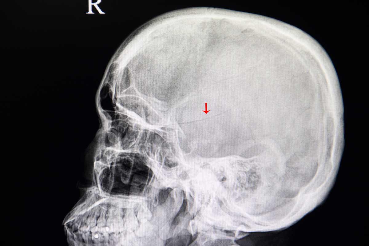 xray image of patient with linear fracture of skull from traumatic injury