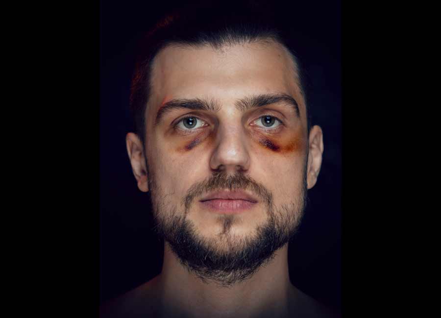 young man with bruise black eye hematoma