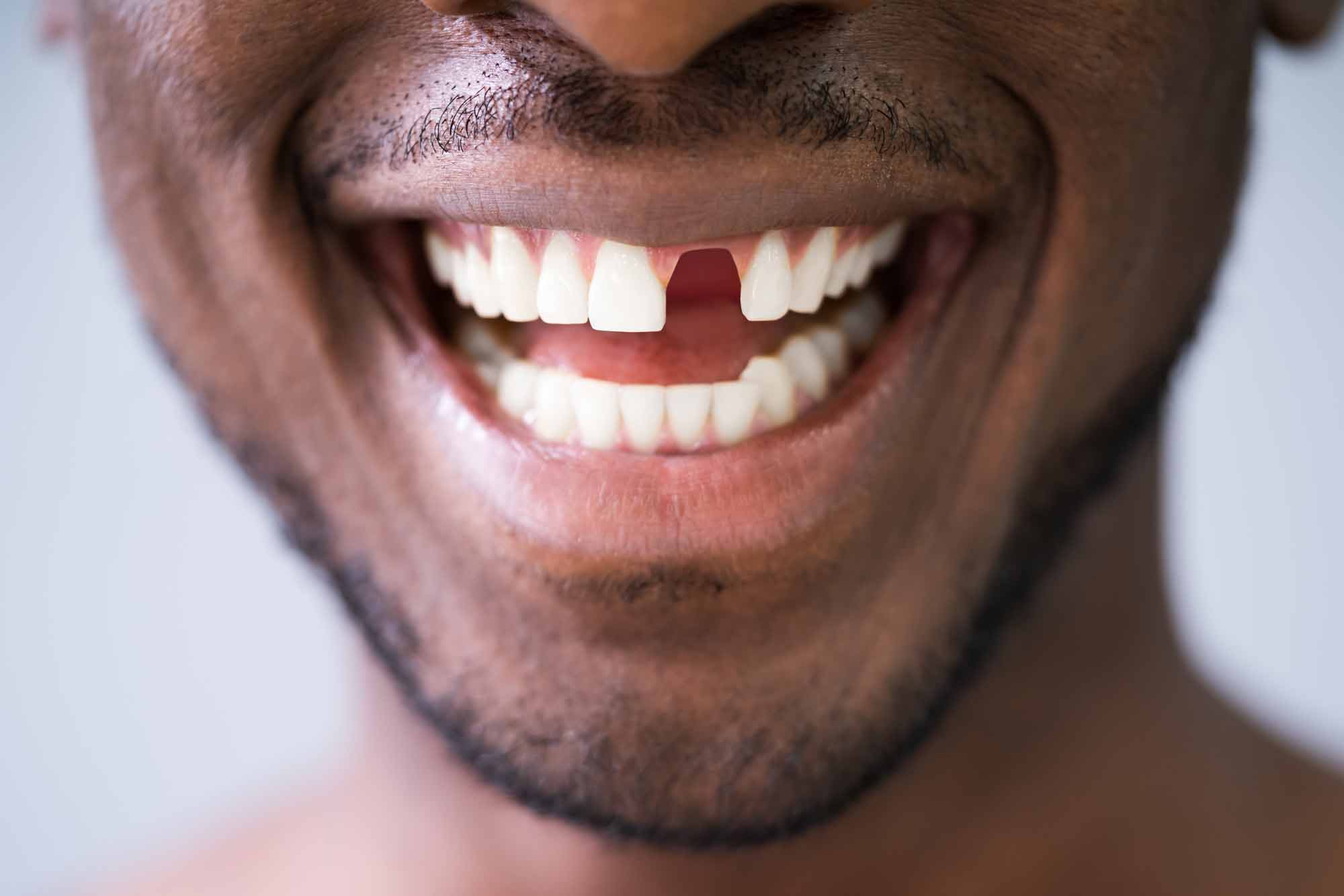 young man with missing tooth